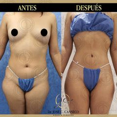 Lipoescultura - Dr. José Carlos Canseco Cavazos