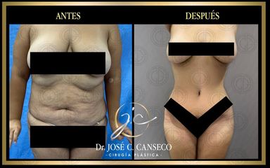 Abdominoplastia - Dr. José Carlos Canseco Cavazos