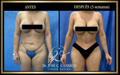 Lipoescultura - Dr. José Carlos Canseco Cavazos