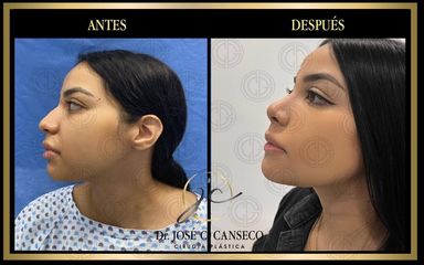 Rinoplastia - Dr. José Carlos Canseco Cavazos