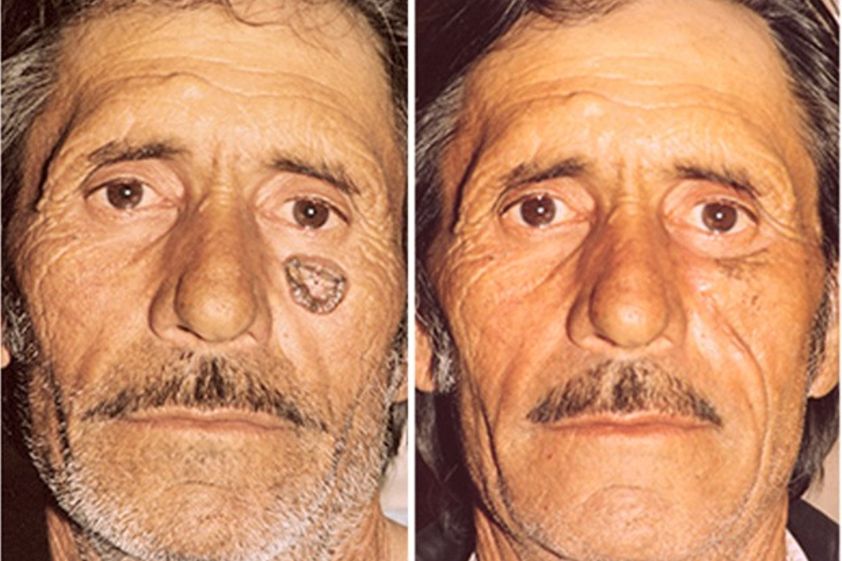 Carcinoma Basocelular antes y después - 498158