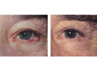 Antes y después de Carcinoma en ojo