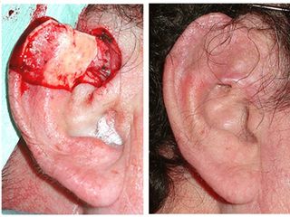 Antes y después de Carcinoma en oreja