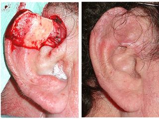 Carcinoma en oreja