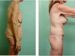 Antes y después Abdominoplastia
