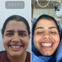 Implantes dentales - Dra. Roxana Alejandra Pérez Clavell