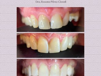 Implantes Dentales - 837627