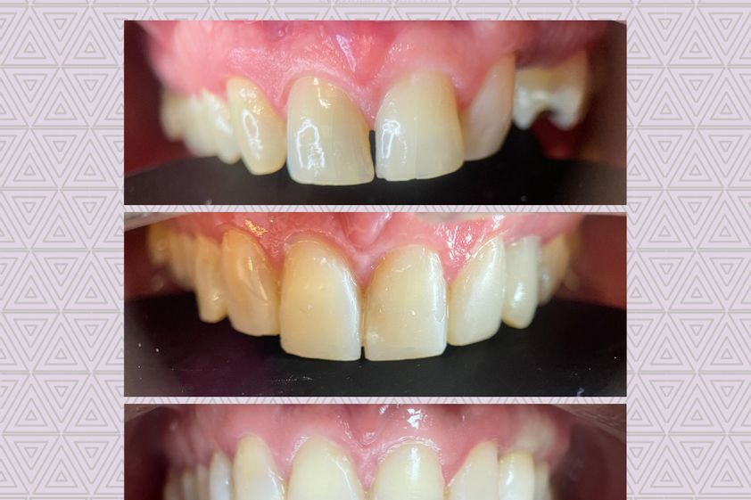 Implantes Dentales antes y después - 837627
