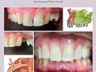 Implantes Dentales - 837628