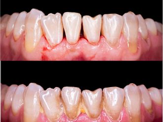 Implantes Dentales - 837629