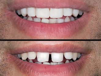 Implantes Dentales - 837630