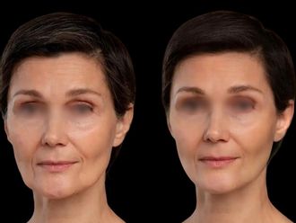 Ácido hialurónico antes y después - 877712