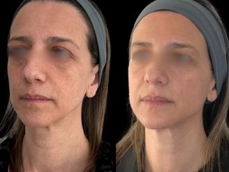 Ácido hialurónico antes y después - 877713