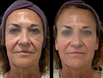 Ácido hialurónico antes y después - 877714