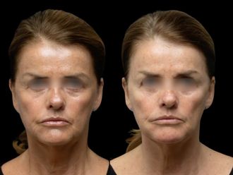 Ácido hialurónico antes y después - 877715