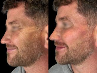 Ácido hialurónico antes y después - 877716