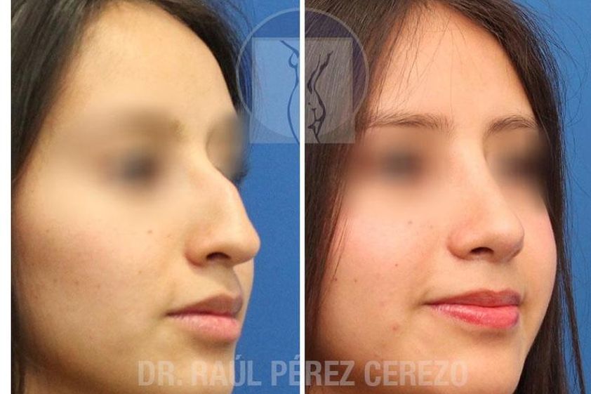 Rinoplastia antes y después - 634781
