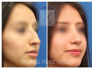 Antes y después de Rinoplastia estética y funcional.