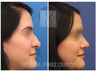 Antes y después de Rinoplastia estética y funcional.