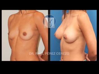 Antes y después de Aumento de busto