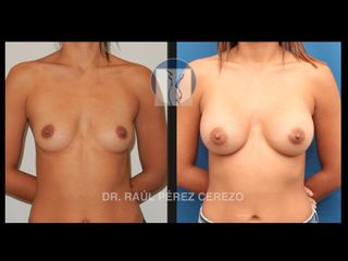 Antes y después de Aumento de busto