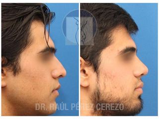 Antes y después de Rinoplastia