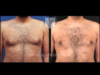 Antes y después de Corrección de Ginecomastia