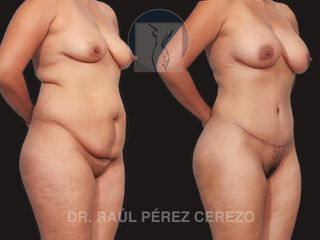 Antes y después de Mommy makeover 