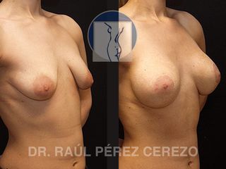 Antes y después de Mastopexia y Aumento de seno