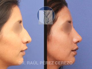 Antes y después de Rinoplastia