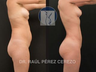 Antes y después de Liposucción 