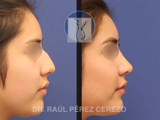 Antes y después de Rinoplastia