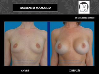 Antes y después de Aumento mamario
