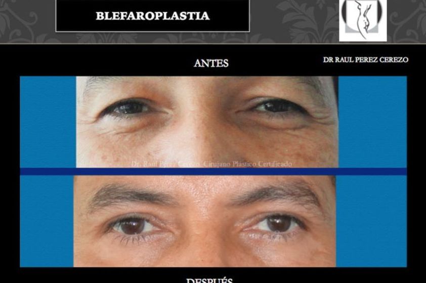 Blefaroplastia antes y después - 640144