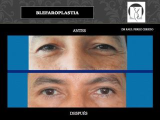 Antes y después de Blefaroplastia