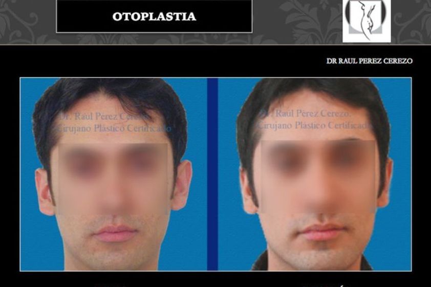 Otoplastia antes y después - 640146