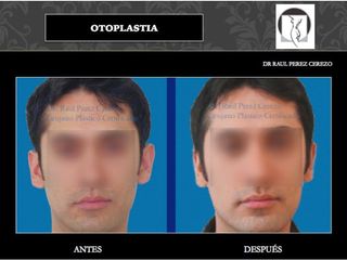 Antes y después de Otoplastia