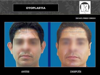 Antes y después de Otoplastia