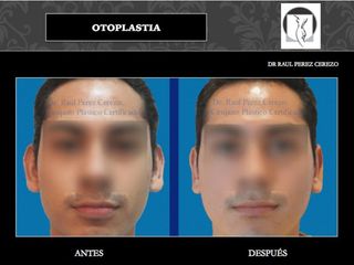 Antes y después de Otoplastia