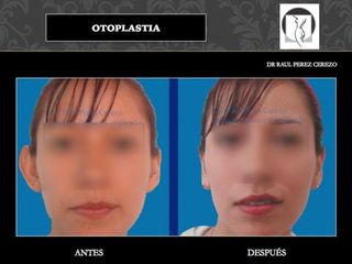 Antes y después de Otoplastia