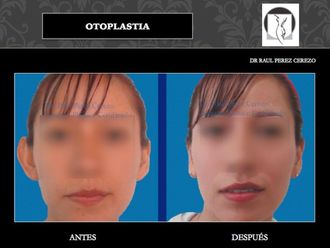 Otoplastia - 640149