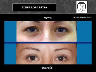 Antes y después de Blefaroplastia