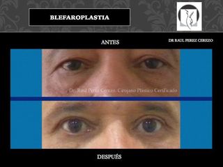 Antes y después de Blefaroplastia