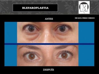 Antes y después de Blefaroplastia