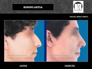 Antes y después de Rinoplastia