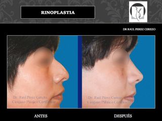 Antes y después de Rinoplastia