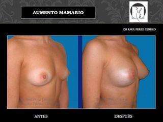 Antes y después de Aumento mamario