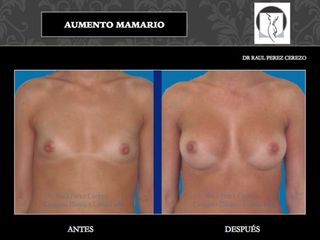 Antes y después de Aumento mamario