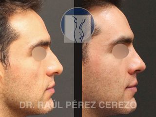 Antes y después de Rinoplastia estetica y funcional