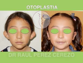 Antes y después de Otoplastia